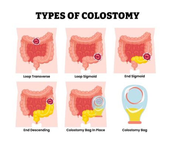 What is a double colostomy?