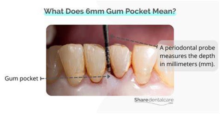 What is a gum pocket?