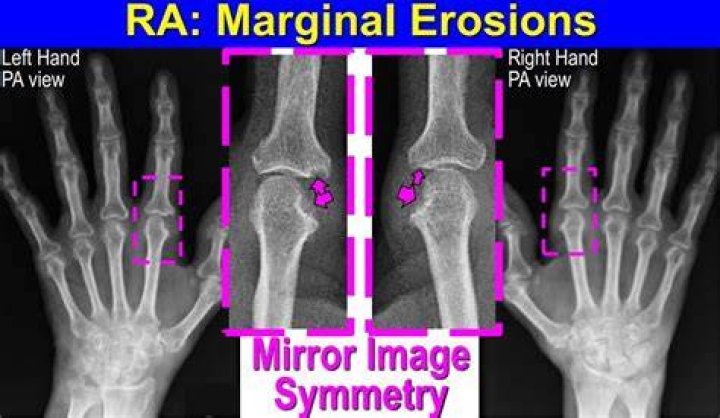 What is a marginal hand?