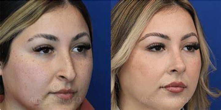 What is a mestizo nose?