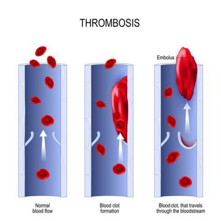What is a thrombosis?