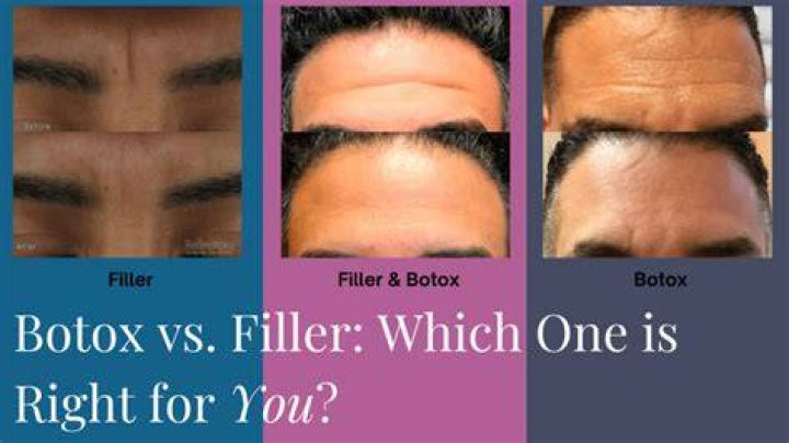 What is better Botox or fillers?
