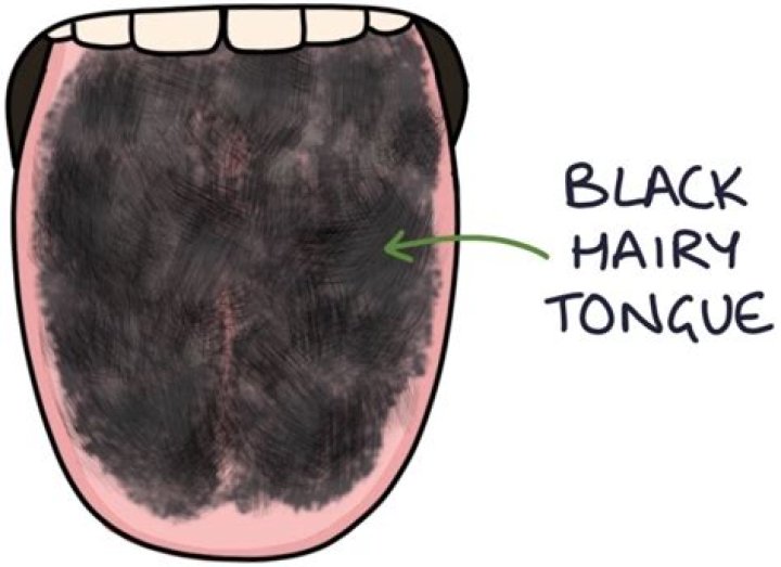 What is black or hairy tongue?