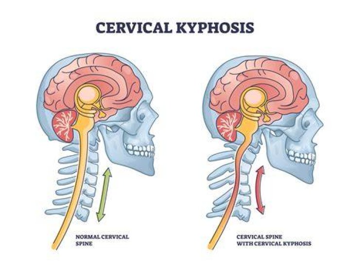 What is military neck Syndrome?