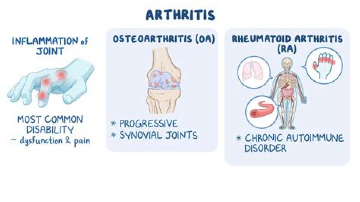 What is more painful osteoarthritis or fibromyalgia?