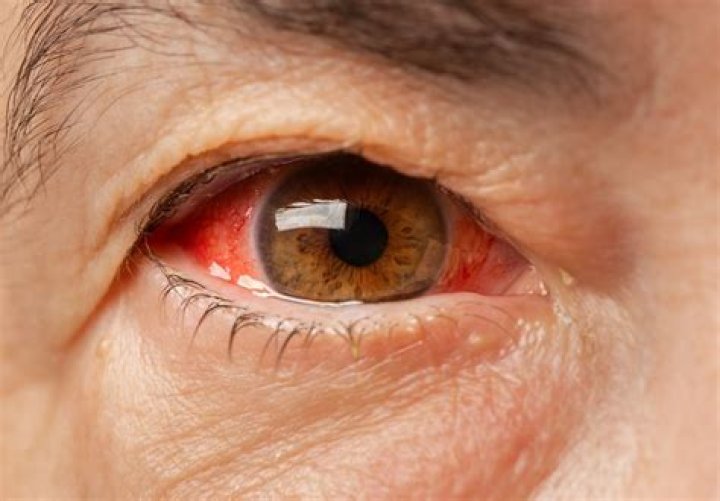What is red Eye red key?