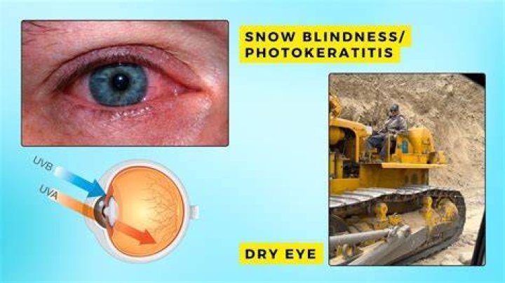What is snow blindness?