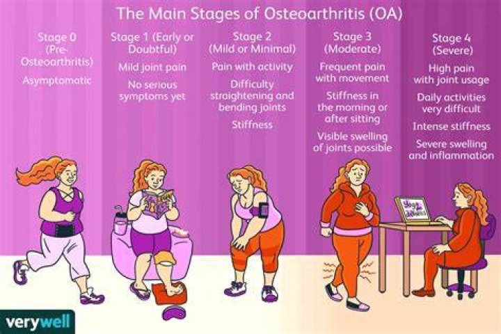 What is the prognosis for osteoarthritis of the spine?
