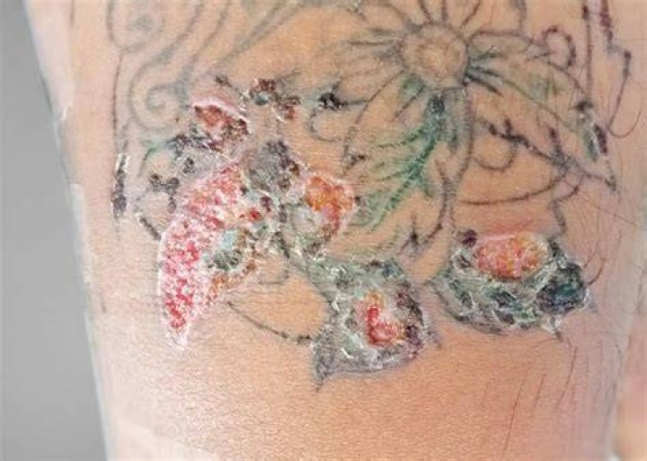 What side effects can tattoos have?