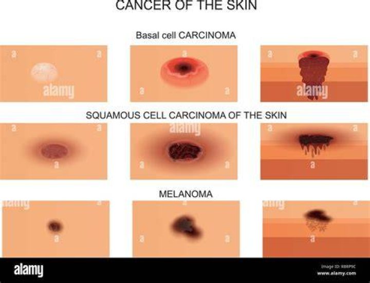 What stage is necrotic wound?