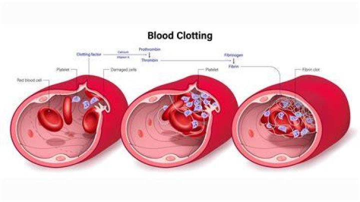 What will happen if you have a blood clot?