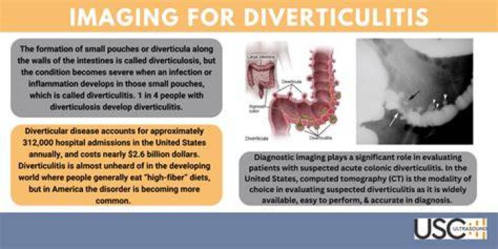 When should you suspect diverticulitis?