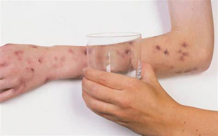 Where does a meningitis rash start?