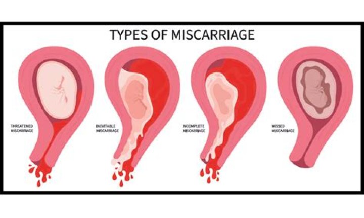 Who is at risk for a missed miscarriage?