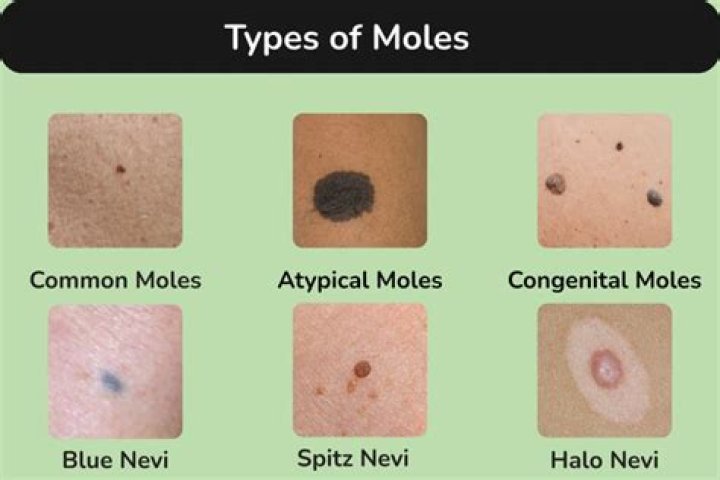 Why am I getting tiny moles on my face?