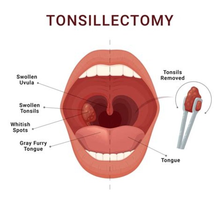 Why do ears hurt after tonsillectomy?