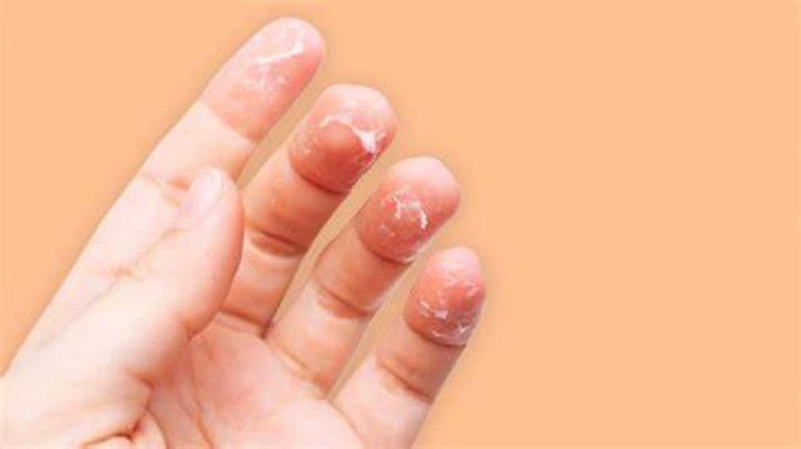 Why do my fingers turn into raisins?