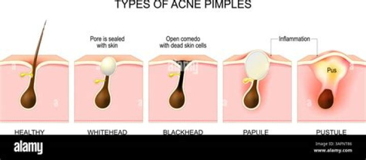 Why does my pimple pus smell like cheese?