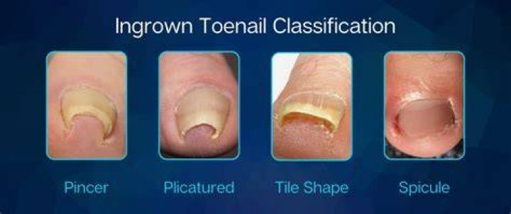 Why does my toenail grow in layers?
