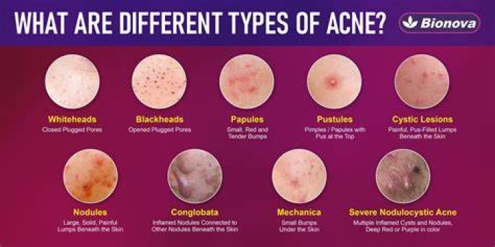 Why is acne so common?