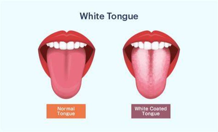 Why is my tongue white even after brushing?