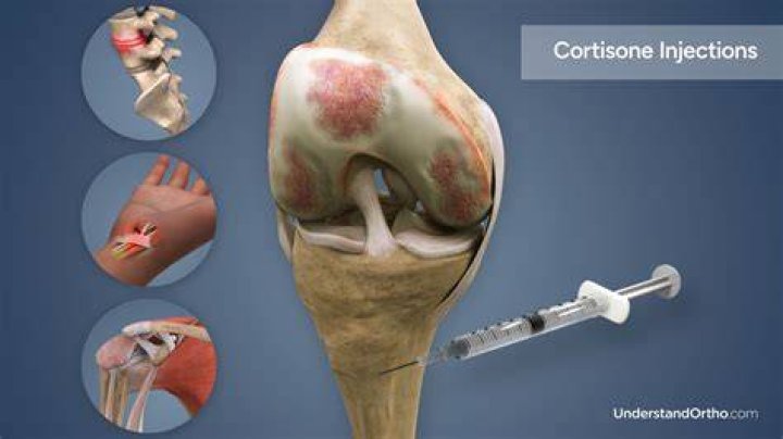 Will a cortisone shot help fibromyalgia?