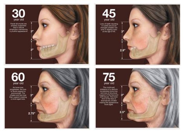 Will dentures help my sagging face?