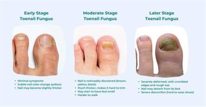 Will toe fungus grow out?